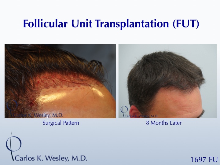 1700 FUT session for a 44-year-old gentleman.  Only 8 months after the procedure, early growth appreciated.