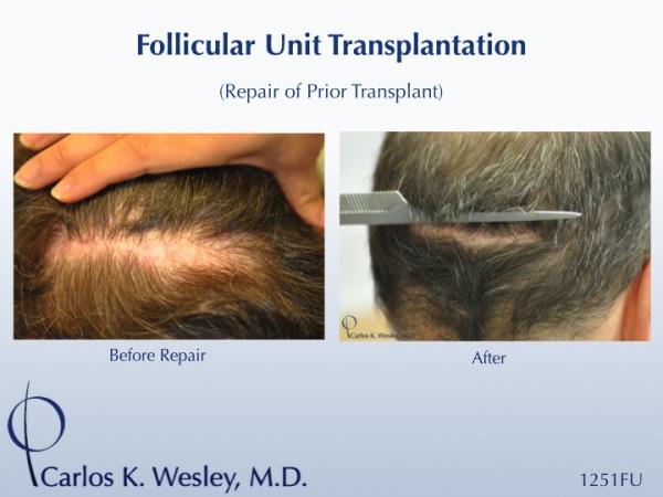 Dr. Wesley repairs a patient's wide donor scar that was created by a hair transplant performed by a different surgeon. 
 
An interactive before/after...
