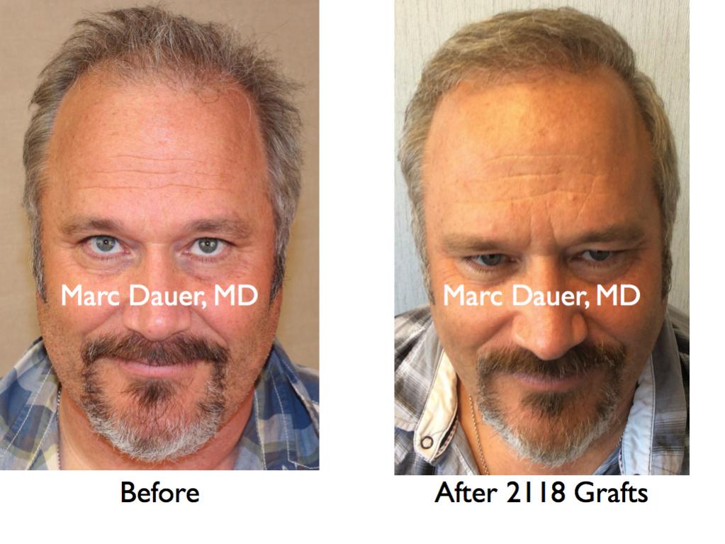 Click image for larger version

Name:	Hair Transplant Slides4.273.jpg

Size:	87.7 KB
ID:	35181