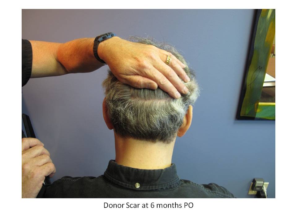 Dr. Paul Shapiro, MD  
FUT 
2693 grafts/5193 hairs 
12 months post-op
