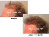 Click image for larger version

Name:	Hair Transplant Slides.747.jpg

Size:	62.8 KB
ID:	41691