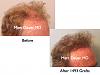 Click image for larger version

Name:	Hair Transplant Slides.748.jpg

Size:	62.2 KB
ID:	41692
