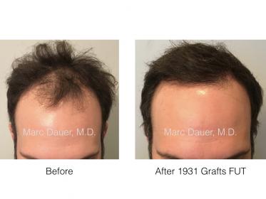 hair transplant photo