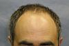 Click image for larger version

Name:	Patient Hairline Before Surgery.jpg

Size:	32.5 KB
ID:	342