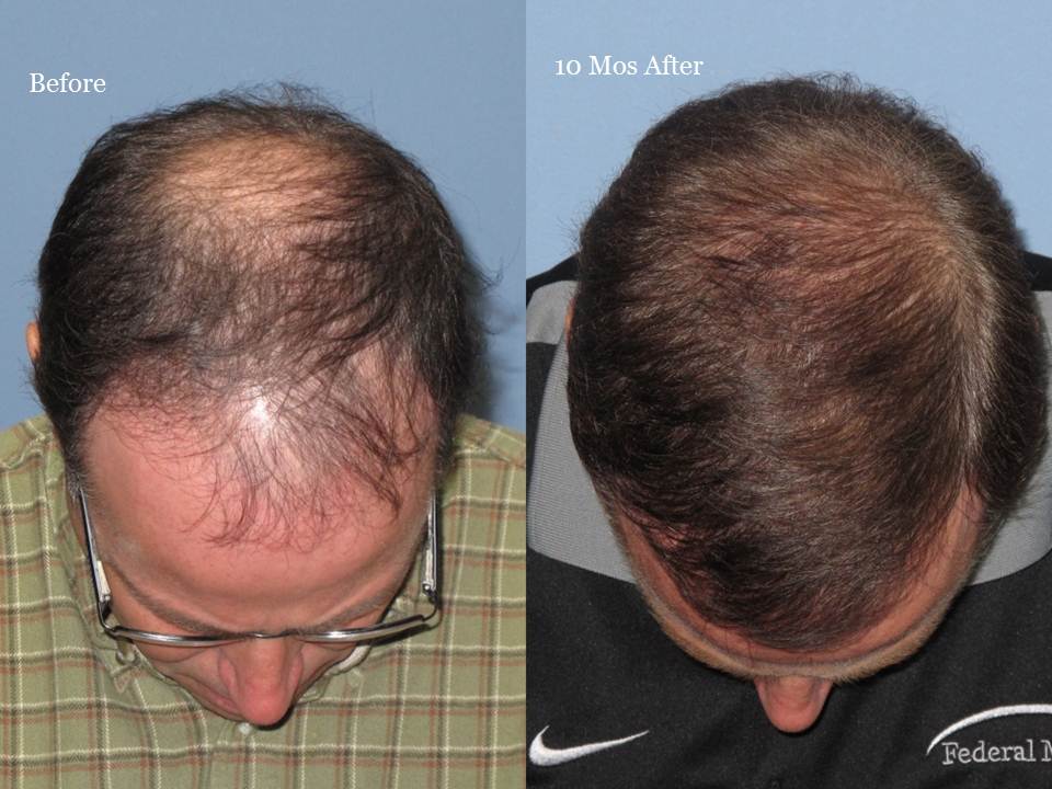 Paul Shapiro, MD 
1st FUT session = 2669 grafts 
2nd FUT session = 1876 grafts 
Total both sessions = 4545 grafts 
10 months post-op