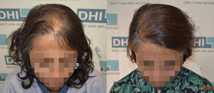 Women hair transplant at DHI