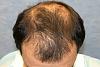 Click image for larger version

Name:	05_before-hair-transplant-top-view.jpg

Size:	60.1 KB
ID:	7307