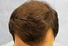 Click image for larger version

Name:	07_after-1st-hair-transplant-top-view.jpg

Size:	56.9 KB
ID:	7309