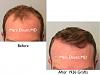 Click image for larger version

Name:	Hair Transplant Slides copy01.001.jpg

Size:	12.1 KB
ID:	48141