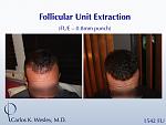 FUE with 0.75mm punch 
Dr. Wesley's patient submitted his own images from home. 
A video of this patient's experience can be viewed here:...