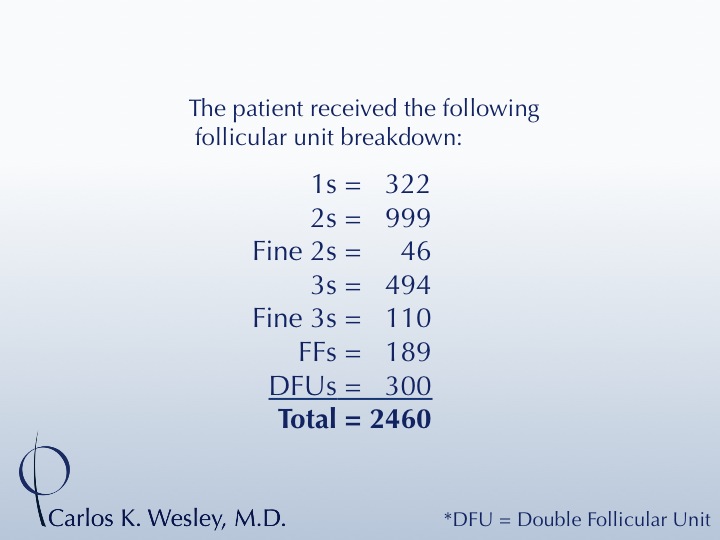 A 40-year-old male underwent a 2460 FU session of FUT with Dr. Carlos K. Wesley (NYC).