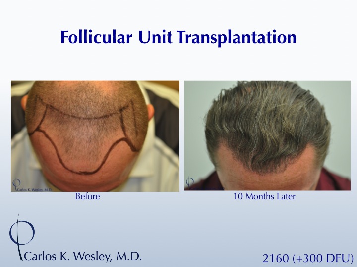 A 40-year-old male underwent a 2460 FU session of FUT with Dr. Carlos K. Wesley (NYC).