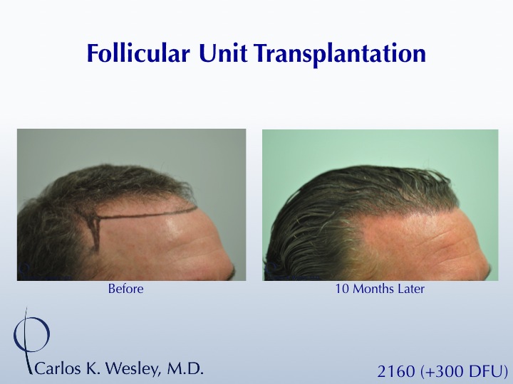 A 40-year-old male underwent a 2460 FU session of FUT with Dr. Carlos K. Wesley (NYC).