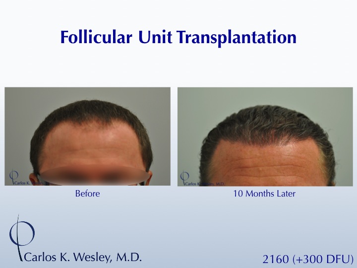 A 40-year-old male underwent a 2460 FU session of FUT with Dr. Carlos K. Wesley (NYC).