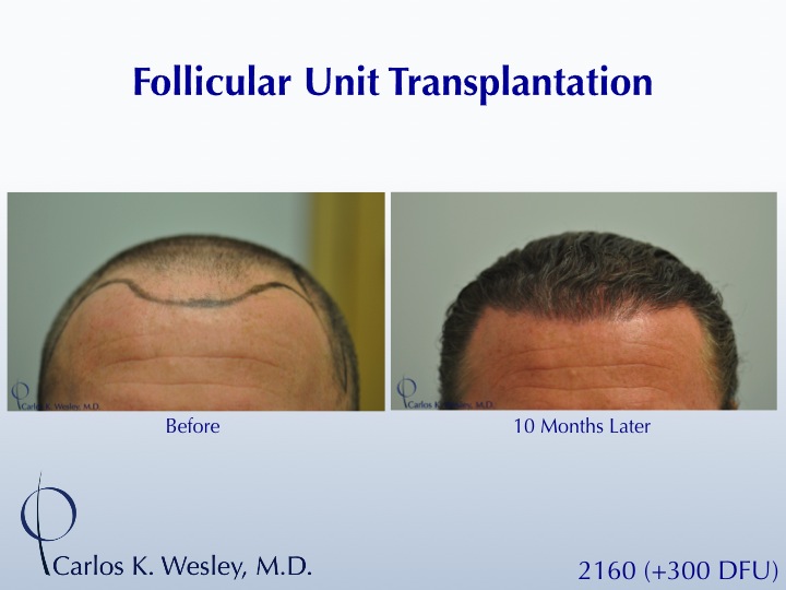 A 40-year-old male underwent a 2460 FU session of FUT with Dr. Carlos K. Wesley (NYC).