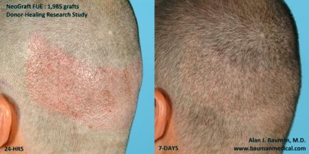 Click image for larger version

Name:	neograft_fue_donor healing_1wk.jpg

Size:	20.0 KB
ID:	23753
