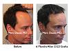 Click image for larger version

Name:	Hair Transplant Slides2.289.jpg

Size:	74.5 KB
ID:	35509