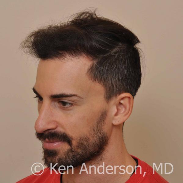 Jason Nicola	 
Norwood 3 
Age: 34 
Surgeon: Dr. Ken Anderson, MD 
Location: Atlanta, Georgia 
	 
Clinical History: 
Jasons initial consultation with...