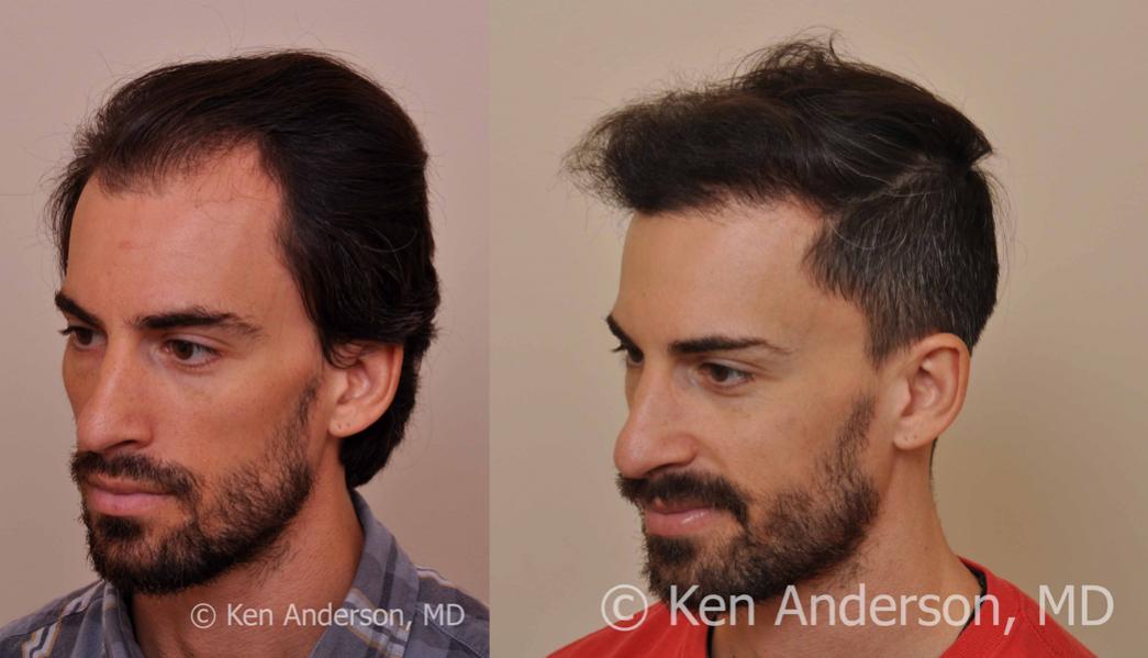 Jason Nicola	 
Norwood 3 
Age: 34 
Surgeon: Dr. Ken Anderson, MD 
Location: Atlanta, Georgia 
	 
Clinical History: 
Jasons initial consultation with...