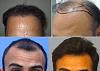 Our Own Hair transplant project