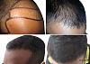 Our Own Hair transplant project