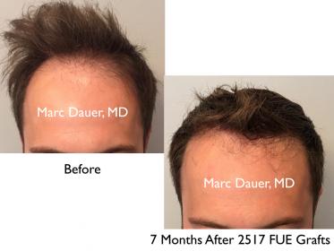 Click image for larger version

Name:	Hair Transplant Slides copy25.001.jpg

Size:	13.7 KB
ID:	45962