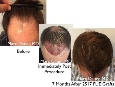 Click image for larger version

Name:	Hair Transplant Slides copy25.004.jpg

Size:	17.7 KB
ID:	45965