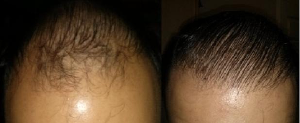 Click image for larger version

Name:	1 Year - Hairline Before & After.jpg

Size:	17.2 KB
ID:	34143