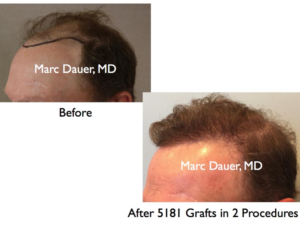Click image for larger version

Name:	Hair Transplant Slides2.393.jpg

Size:	58.2 KB
ID:	36737