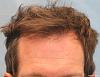 After Hair Transplant - Detail of Hairline