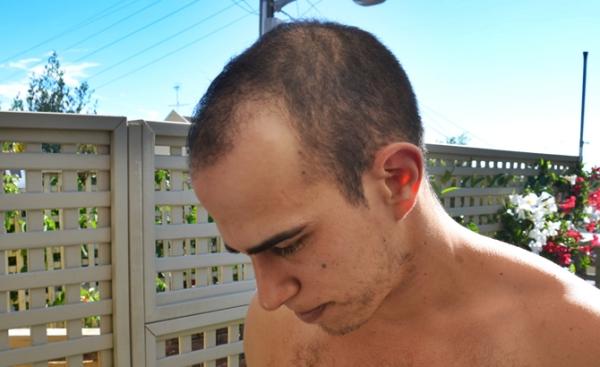 KD LSide On Down 15022012 
Pre FUE Hair Transplant Dr Woods 
www.fuehairtransplanttruth.com