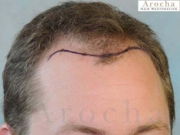 Twenty-nine year gentleman wanted to have a natural looking hair transplant to restore the framing of his face. Arocha Hair Restoration performed a...