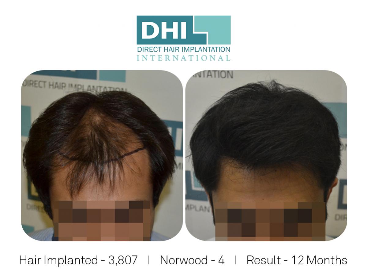 Norwood Scale 4, 3807 hair implanted