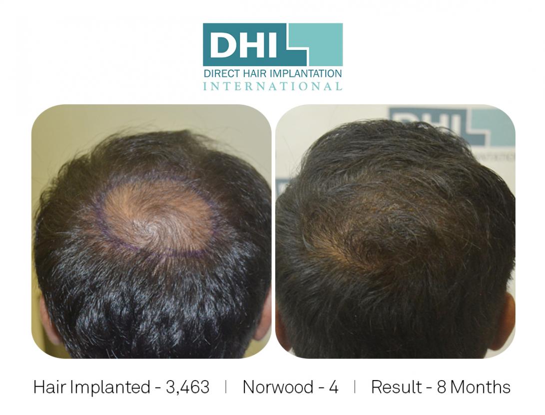 Norwood Scale 4, Hair Implanted 3463, 10 Month Results.