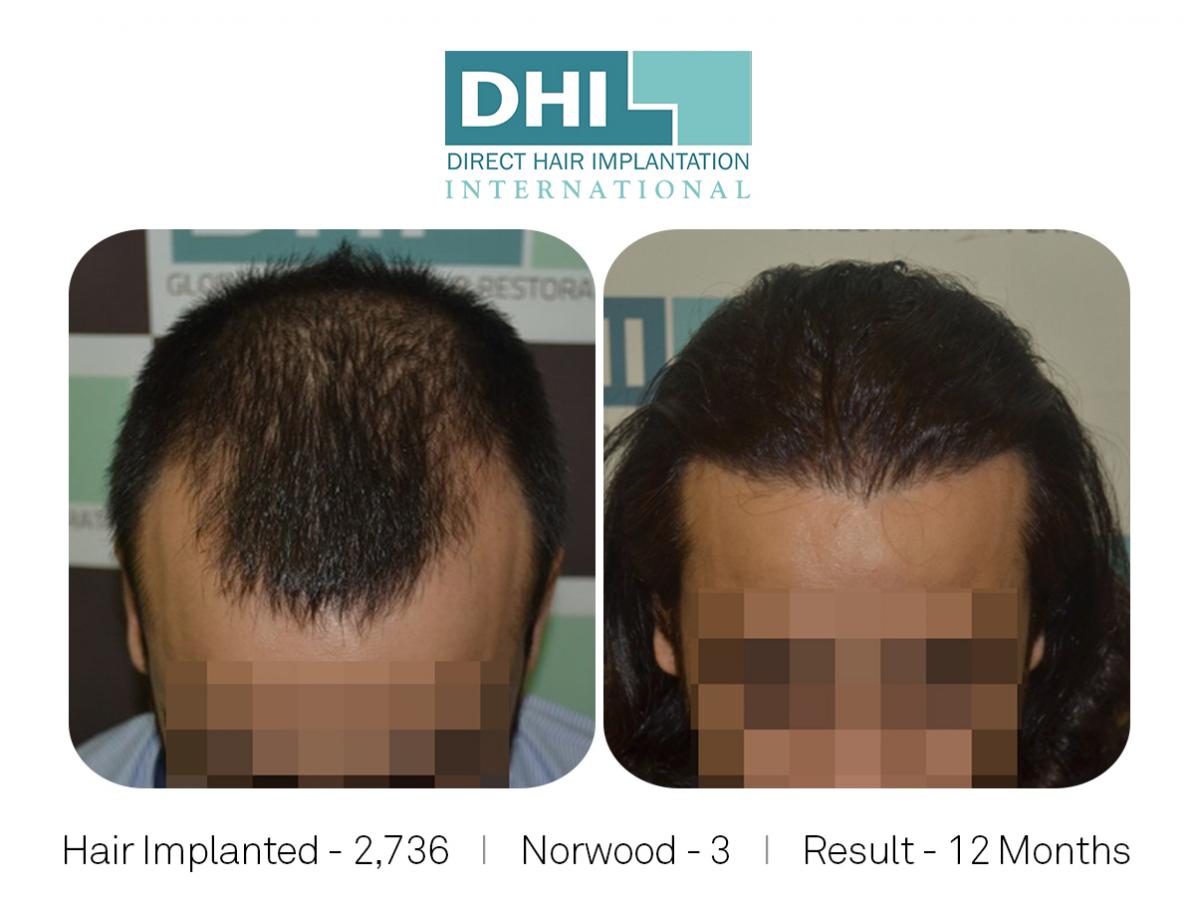 Norwood 3, Hair Implanted 2736.