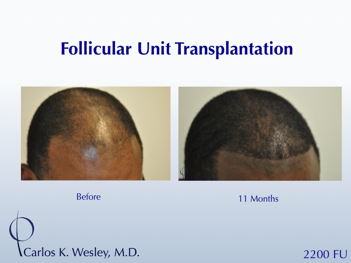 A 35-year-old African-American male underwent a 2200 FU session with Dr. Carlos K. Wesley (NYC).