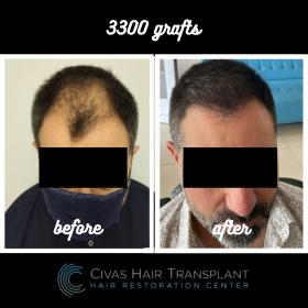 Procedure: FUE Hair Transplant 
Number of grafts: 3300 Grafts
