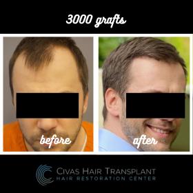 Procedure: FUE Hair Transplant 
Number of grafts: 3000 Grafts