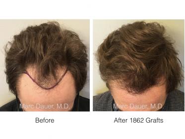 Patient of Dr. Marc Dauer who received 1862 grafts via FUT.