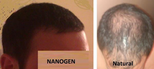 My hair with Nanogen and without..