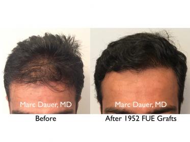 Click image for larger version

Name:	Hair Transplant Slides copy88.004.jpg

Size:	13.3 KB
ID:	47672