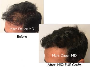 Click image for larger version

Name:	Hair Transplant Slides copy88.002.jpg

Size:	13.0 KB
ID:	47673