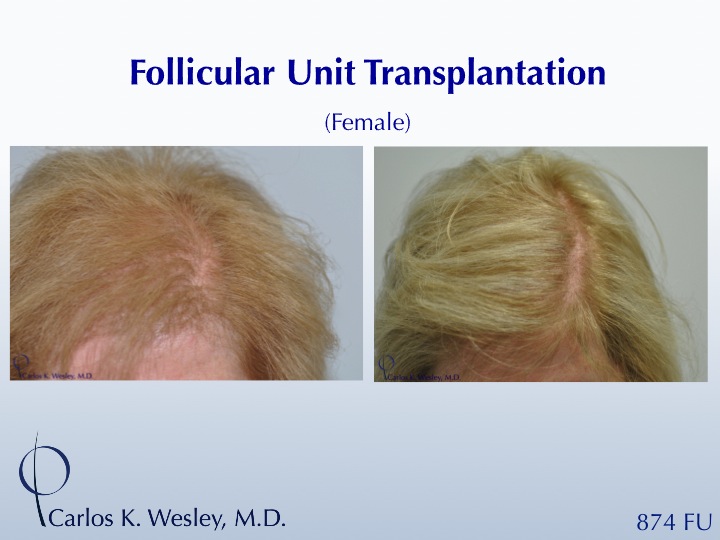 An interactive before/after image of this patient can be viewed at: 
 
www.drcarloswesley.com/hairline06.html