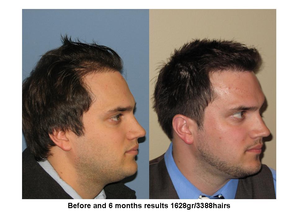 Dr. Paul Shapiro, MD  
FUT  
1628 grafts/ 3388 hairs 
6 months post-op