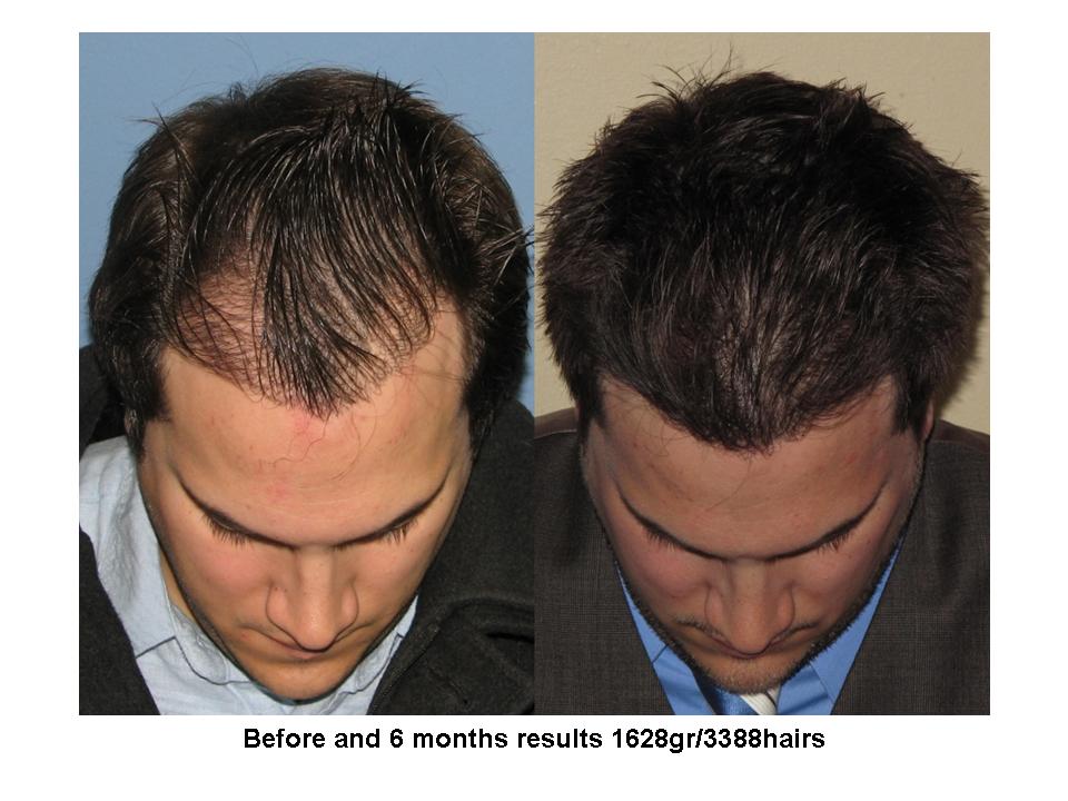 Dr. Paul Shapiro, MD  
FUT  
1628 grafts/ 3388 hairs 
6 months post-op