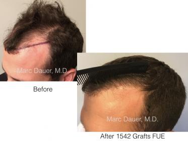 1542 FUE Grafts by Dr. Marc Dauer