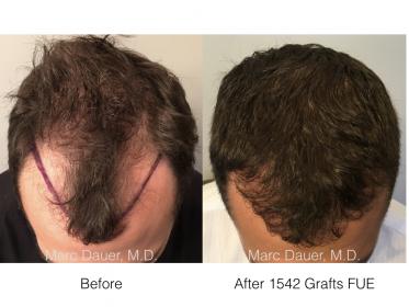 1542 FUE Grafts by Dr. Marc Dauer