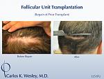 Dr. Wesley repairs a patient's wide donor scar that was created by a hair transplant performed by a different surgeon. 
 
An interactive before/after...