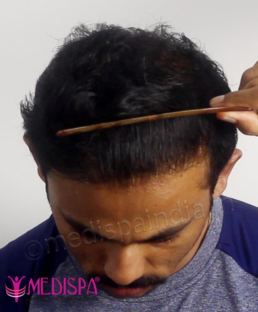 Click image for larger version

Name:	23_Comb Hairline.jpg

Size:	79.7 KB
ID:	67434