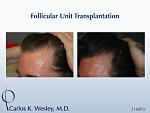 Before/After 2160 grafts 
Dr. Carlos K. Wesley in New York City